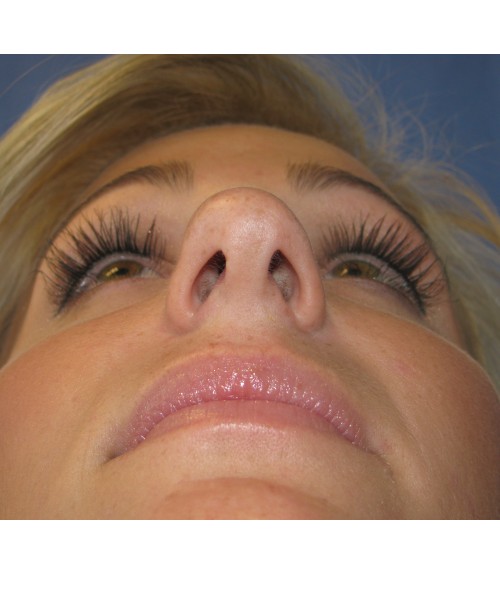 Rhinoplasty Case 7017 Click HERE for more views before photo. Individual results may vary.