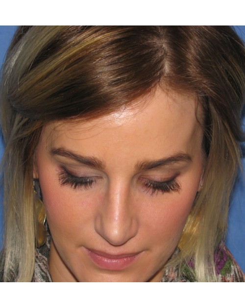 Rhinoplasty Case 7017 Click HERE for more views after photo. Individual results may vary.