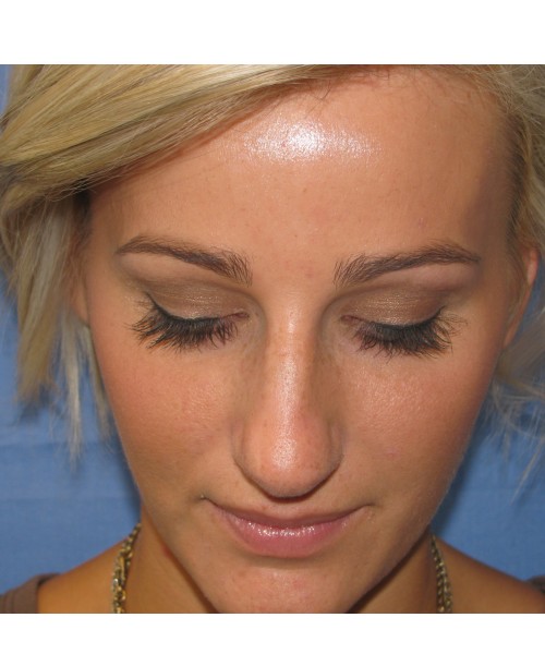 Rhinoplasty Case 7017 Click HERE for more views before photo. Individual results may vary.