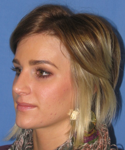 Rhinoplasty Case 7017 Click HERE for more views after photo. Individual results may vary.