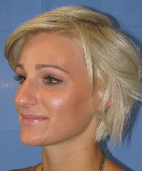 Rhinoplasty Case 7017 Click HERE for more views before photo. Individual results may vary.