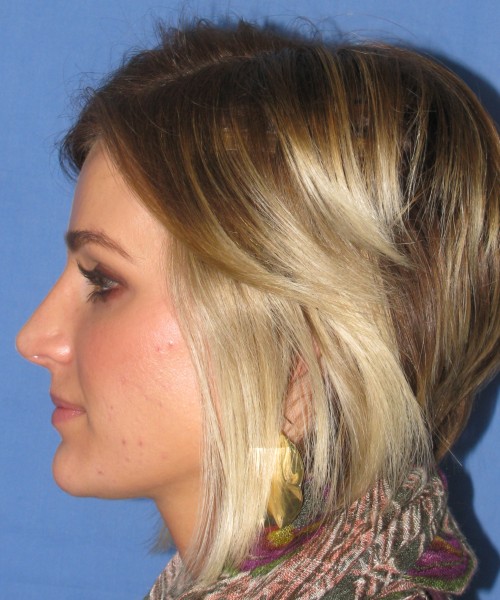 Rhinoplasty Case 7017 Click HERE for more views after photo. Individual results may vary.