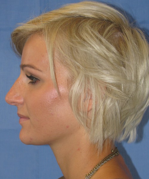 Rhinoplasty Case 7017 Click HERE for more views before photo. Individual results may vary.