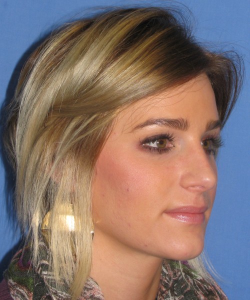 Rhinoplasty Case 7017 Click HERE for more views after photo. Individual results may vary.