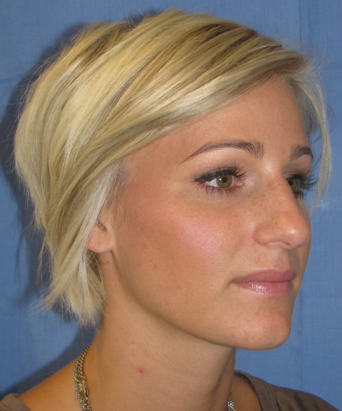 Rhinoplasty Case 7017 Click HERE for more views before photo. Individual results may vary.