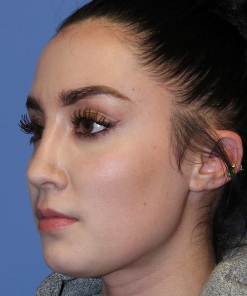 Rhinoplasty 4548 Click HERE for more views after photo. Individual results may vary.