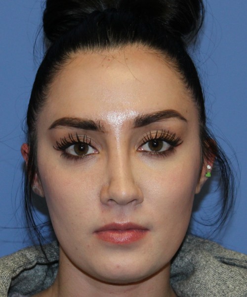 Rhinoplasty 4548 Click HERE for more views after photo. Individual results may vary.