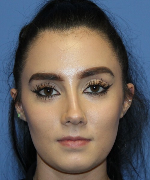 Rhinoplasty 4548 Click HERE for more views before photo. Individual results may vary.