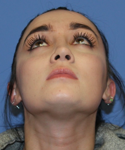 Rhinoplasty 4548 Click HERE for more views after photo. Individual results may vary.