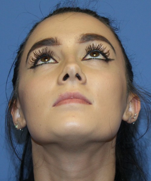 Rhinoplasty 4548 Click HERE for more views before photo. Individual results may vary.