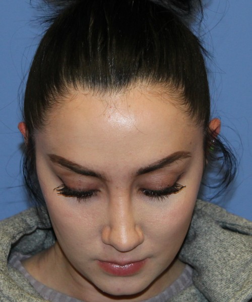 Rhinoplasty 4548 Click HERE for more views after photo. Individual results may vary.