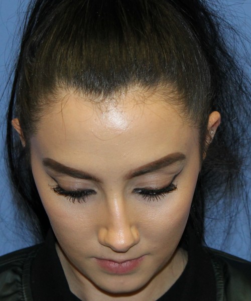 Rhinoplasty 4548 Click HERE for more views before photo. Individual results may vary.