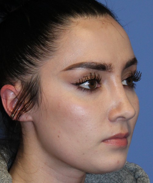 Rhinoplasty 4548 Click HERE for more views after photo. Individual results may vary.