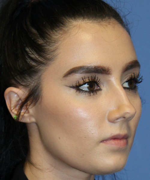 Rhinoplasty 4548 Click HERE for more views before photo. Individual results may vary.