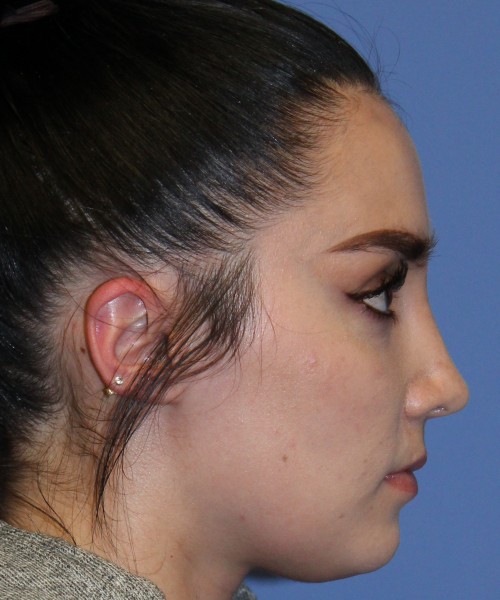 Rhinoplasty 4548 Click HERE for more views after photo. Individual results may vary.