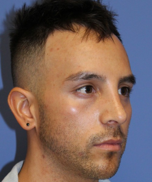 Rhinoplasty 4569 – Click HERE for more views after photo. Individual results may vary.