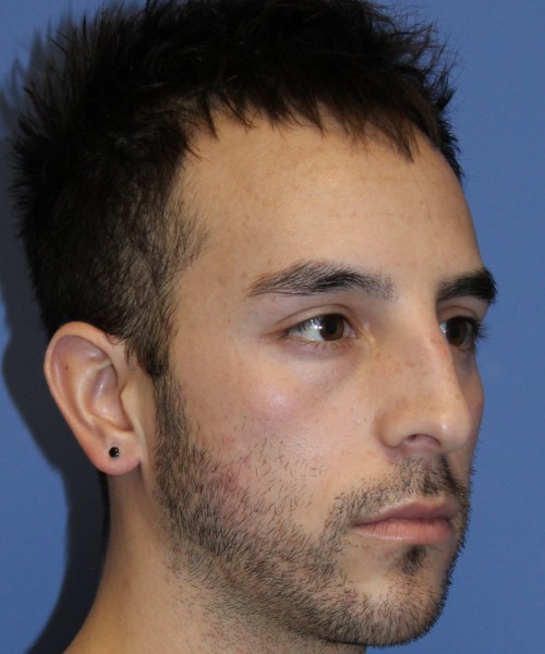 Rhinoplasty 4569 – Click HERE for more views before photo. Individual results may vary.