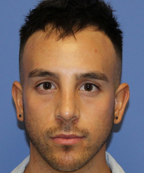 Rhinoplasty 4569 – Click HERE for more views after photo. Individual results may vary.