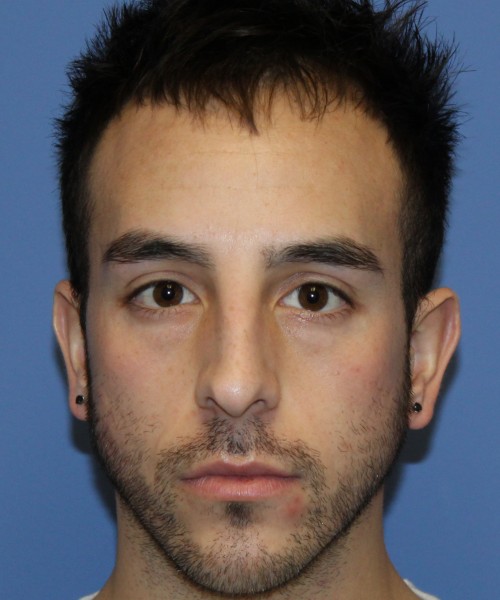 Rhinoplasty 4569 – Click HERE for more views before photo. Individual results may vary.