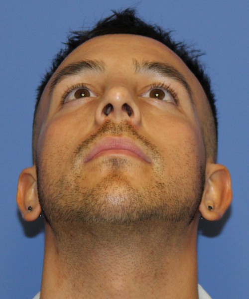 Rhinoplasty 4569 – Click HERE for more views after photo. Individual results may vary.