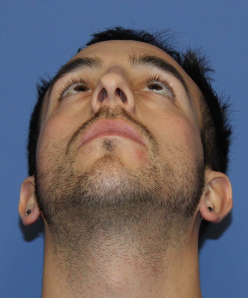 Rhinoplasty 4569 – Click HERE for more views before photo. Individual results may vary.