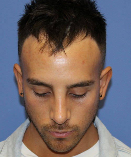 Rhinoplasty 4569 – Click HERE for more views after photo. Individual results may vary.