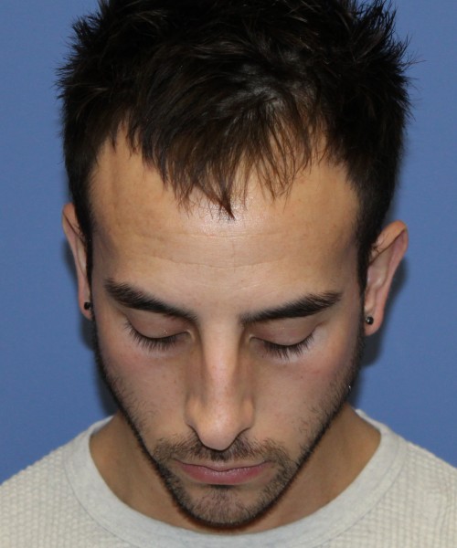 Rhinoplasty 4569 – Click HERE for more views before photo. Individual results may vary.