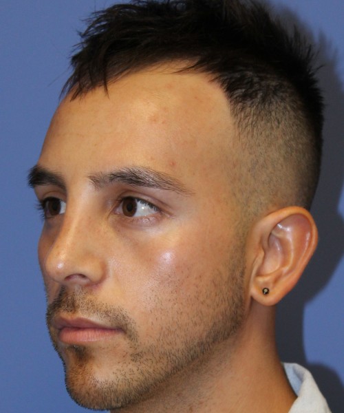 Rhinoplasty 4569 – Click HERE for more views after photo. Individual results may vary.