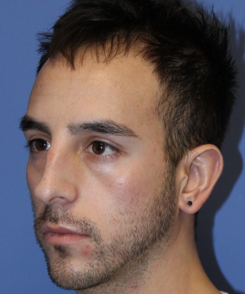 Rhinoplasty 4569 – Click HERE for more views before photo. Individual results may vary.