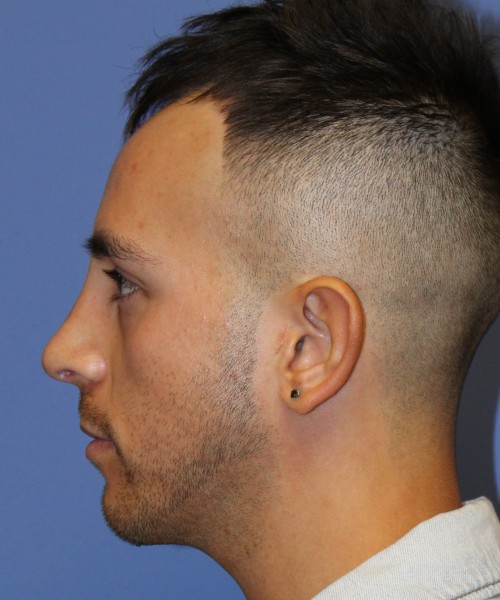 Rhinoplasty 4569 – Click HERE for more views after photo. Individual results may vary.