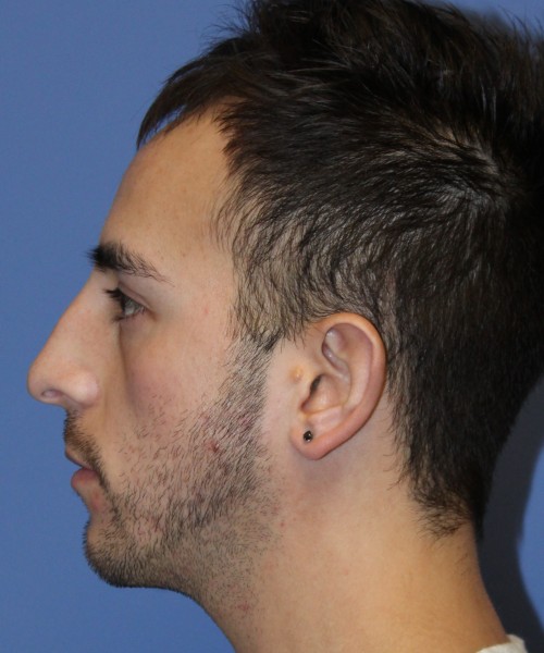 Rhinoplasty 4569 – Click HERE for more views before photo. Individual results may vary.