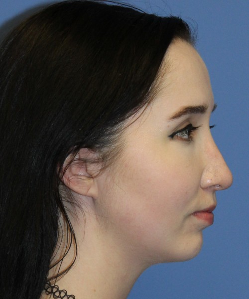 Rhinoplasty, Chin Augmentation 4599 – Click HERE for more views after photo. Individual results may vary.