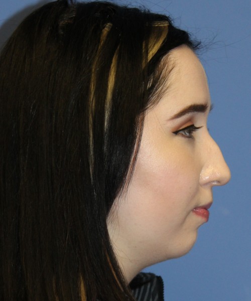 Rhinoplasty, Chin Augmentation 4599 – Click HERE for more views before photo. Individual results may vary.