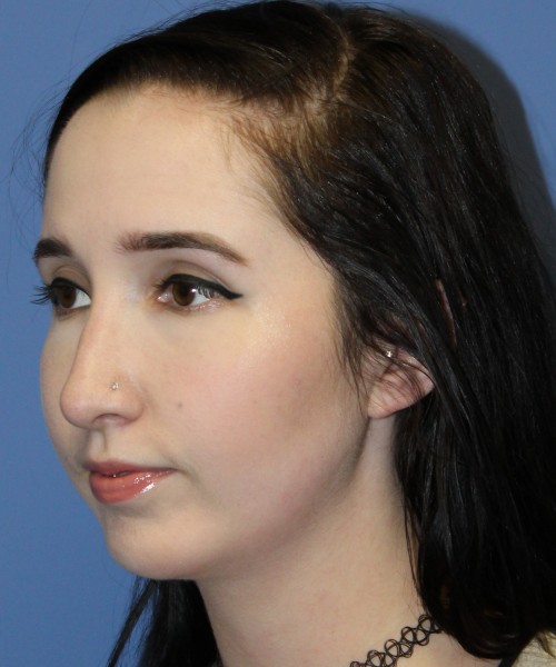 Rhinoplasty, Chin Augmentation 4599 – Click HERE for more views after photo. Individual results may vary.