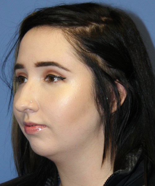 Rhinoplasty, Chin Augmentation 4599 – Click HERE for more views before photo. Individual results may vary.