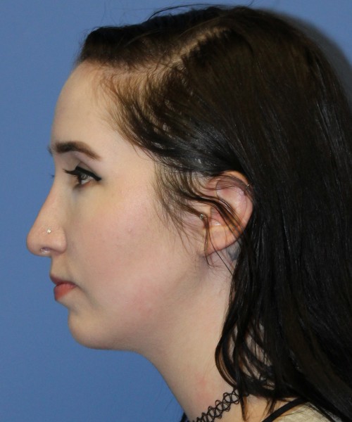 Rhinoplasty, Chin Augmentation 4599 – Click HERE for more views after photo. Individual results may vary.