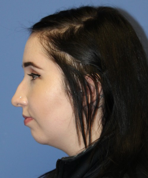 Rhinoplasty, Chin Augmentation 4599 – Click HERE for more views before photo. Individual results may vary.