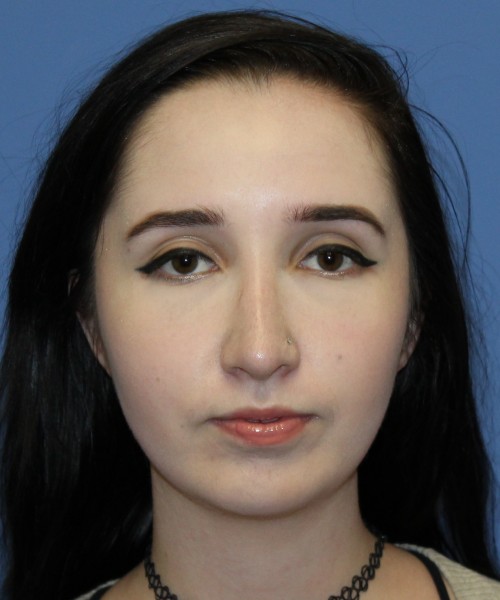 Rhinoplasty, Chin Augmentation 4599 – Click HERE for more views after photo. Individual results may vary.
