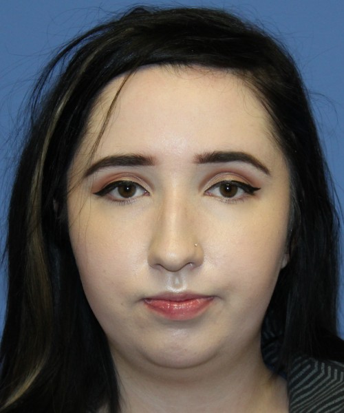 Rhinoplasty, Chin Augmentation 4599 – Click HERE for more views before photo. Individual results may vary.