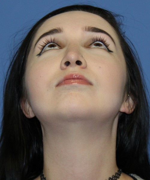 Rhinoplasty, Chin Augmentation 4599 – Click HERE for more views after photo. Individual results may vary.