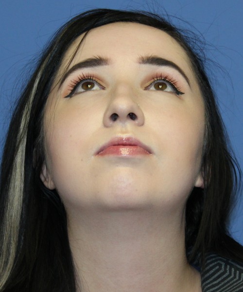 Rhinoplasty, Chin Augmentation 4599 – Click HERE for more views before photo. Individual results may vary.