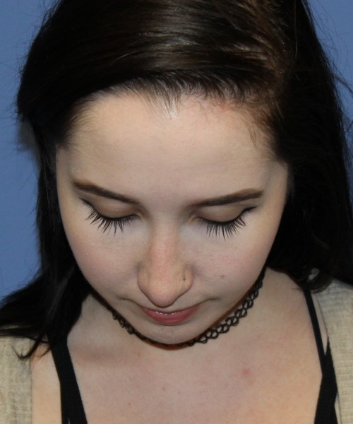 Rhinoplasty, Chin Augmentation 4599 – Click HERE for more views after photo. Individual results may vary.