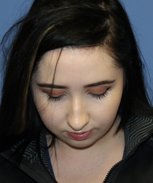 Rhinoplasty, Chin Augmentation 4599 – Click HERE for more views before photo. Individual results may vary.