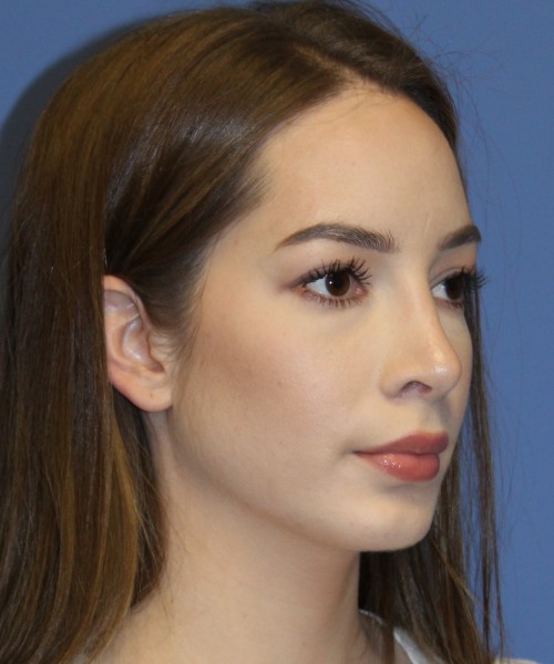 Rhinoplasty, Chin Augmentation 4614 – Click HERE for more views after photo. Individual results may vary.