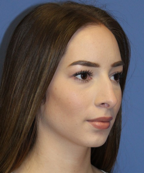 Rhinoplasty, Chin Augmentation 4614 – Click HERE for more views before photo. Individual results may vary.