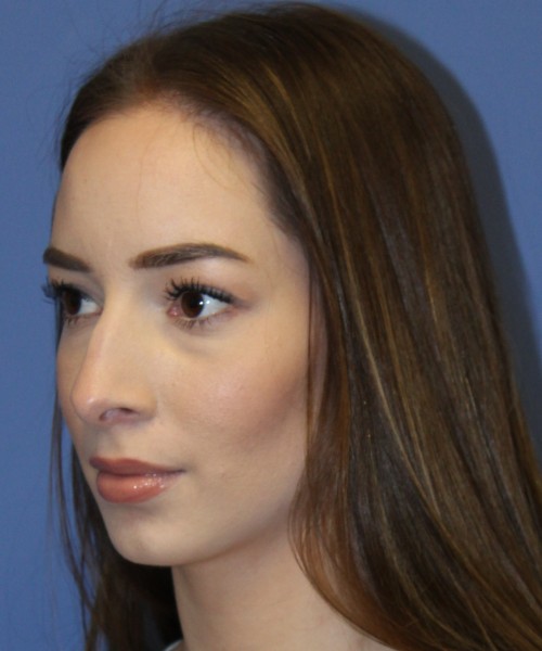 Rhinoplasty, Chin Augmentation 4614 – Click HERE for more views before photo. Individual results may vary.