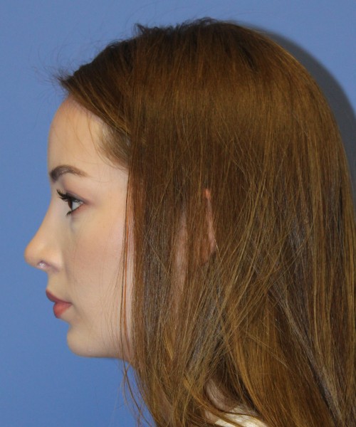 Rhinoplasty, Chin Augmentation 4614 – Click HERE for more views after photo. Individual results may vary.
