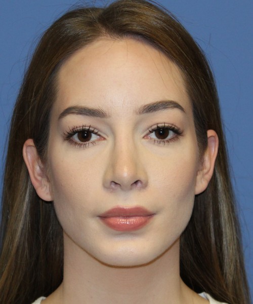 Rhinoplasty, Chin Augmentation 4614 – Click HERE for more views after photo. Individual results may vary.