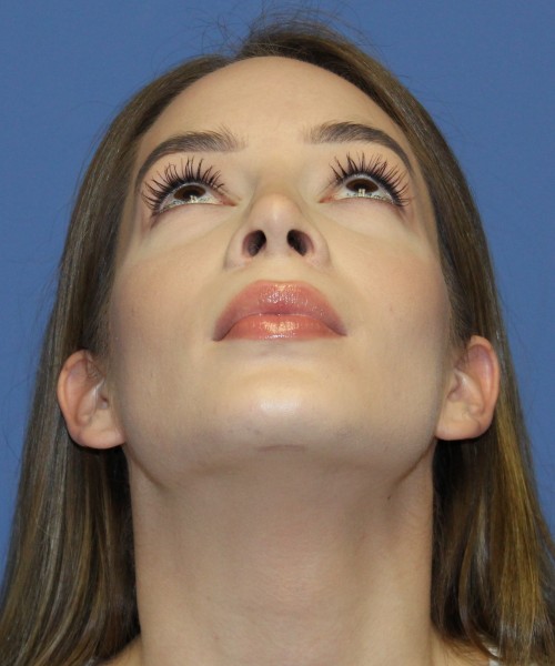 Rhinoplasty, Chin Augmentation 4614 – Click HERE for more views after photo. Individual results may vary.