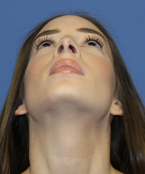 Rhinoplasty, Chin Augmentation 4614 – Click HERE for more views before photo. Individual results may vary.